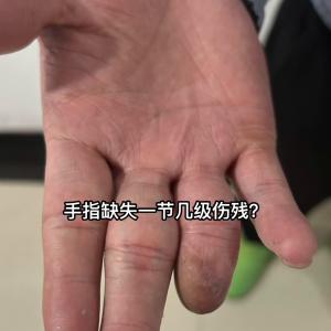 手指缺失一节几级伤残？实践中给你经验，结论在视频最后  第1张